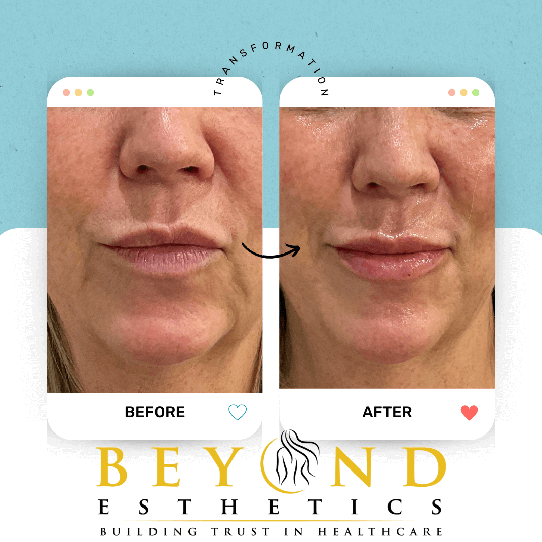 Chin contour - facial balancin